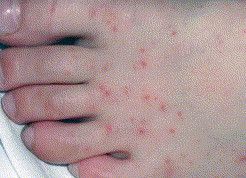 Dunrite Ratbite Fever